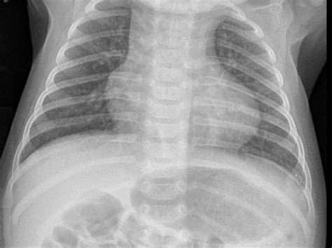 The primary arteries (the aorta and the pulmonary artery) are transposed. Congenital Anomalies: Congenital Heart Disease | 2015-02 ...
