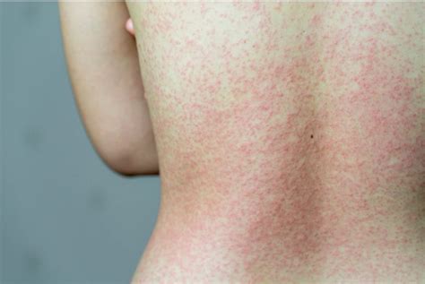 How May Coronavirus Symptoms Covid 19 Manifest On The Skin Skinive