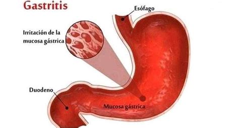Gastritis Efectos Secundarios Tratamientos Síntomas
