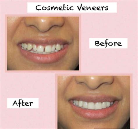 Veneers Before And After Porcelain Composite Gaps Results