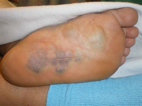 Lymphangioma Of The Foot A Case Report The Foot And Ankle Online Journal