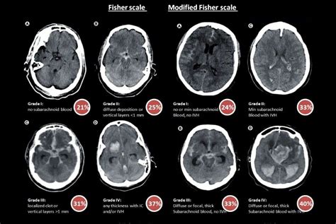 Subarachnoid Hemorrhage Fisher Scale Radiología Neurología