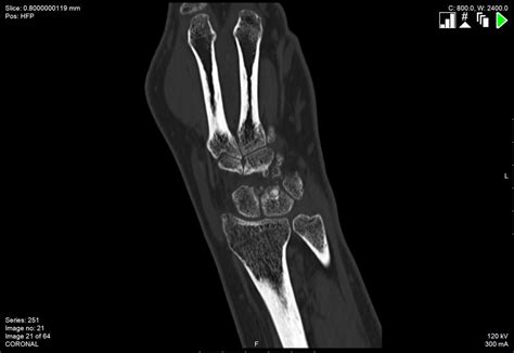 Persistent Wrist Monarthritis Down To The Bone Bmj Case Reports