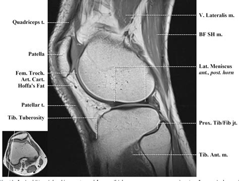 Pdf Normal Mr Imaging Anatomy Of The Knee Semantic Scholar