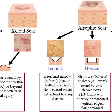 Figure1 Samples From Five Different Types Of Acne Scars And Their