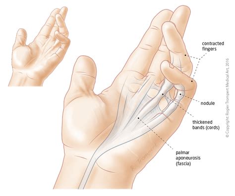 Dupuytrens Contracture Hand Surgery Hand Specialist Montreal And Ottawa Clinic