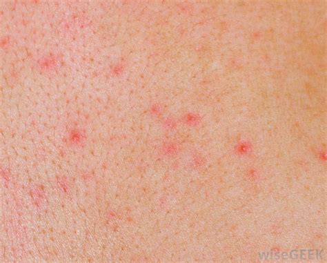 Eczema Little Red Dots Dorothee Padraig South West Skin