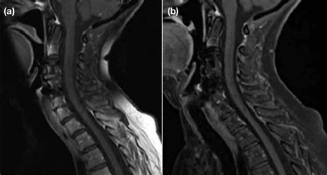 Sagittal T1 Weighted Images Of The Cervical Spine U S I N G A C O N