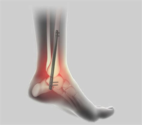 Ankle Tibiotalar Joint Arthrodesis Griportho