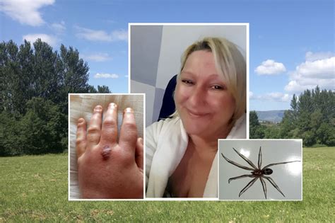 Spider Bite Horror Lands Mum In Hospital After Venomous False Widow