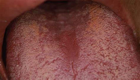 Kissing Lesions Decisions In Dentistry