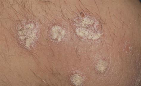 Comparing Biologics For The Long Term Treatment Of Plaque Psoriasis