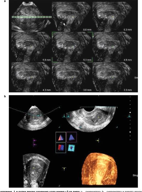Figure 4 From Ultrasound Assessment Of The Uterine Wall After