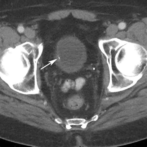 An Axial Portal Venous Phase Contrast Enhanced Ct Image Throught The