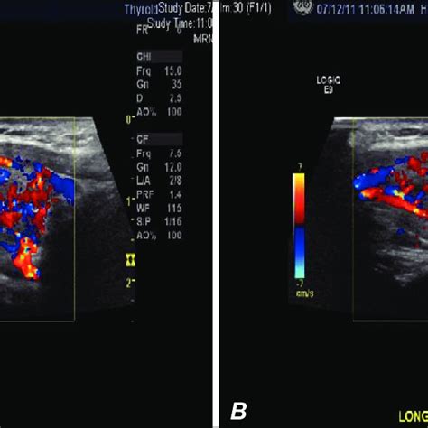 Doppler Ultrasonography Longitudinal View Of The Right Lobe Of The