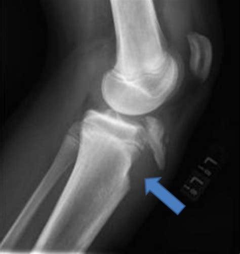 Patella Tendon Rupture X Ray