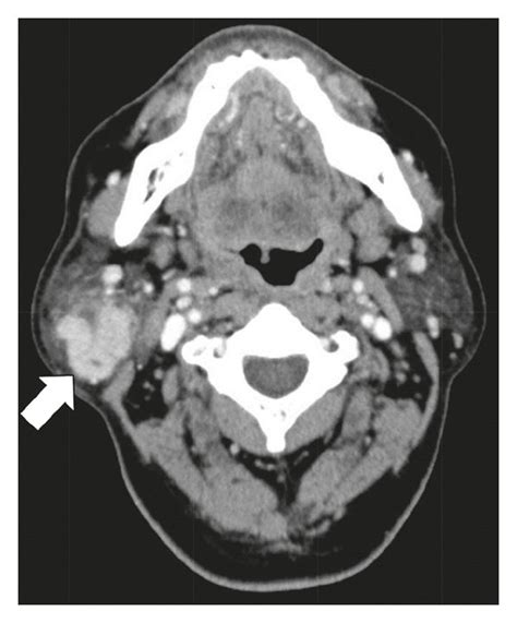 Postcontrast Computed Tomography Ct Findings The Right Parotid Gland