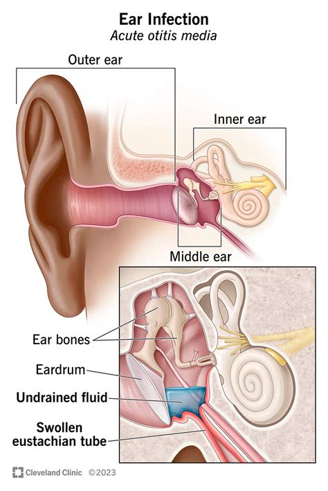 Ear Infection Otitis Media Symptoms Causes And Treatment