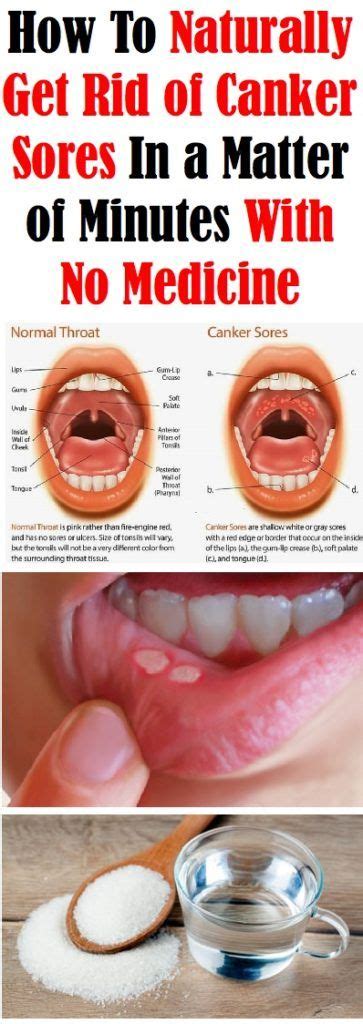 How To Naturally Get Rid Of Canker Sores In Minutes With No Medicine