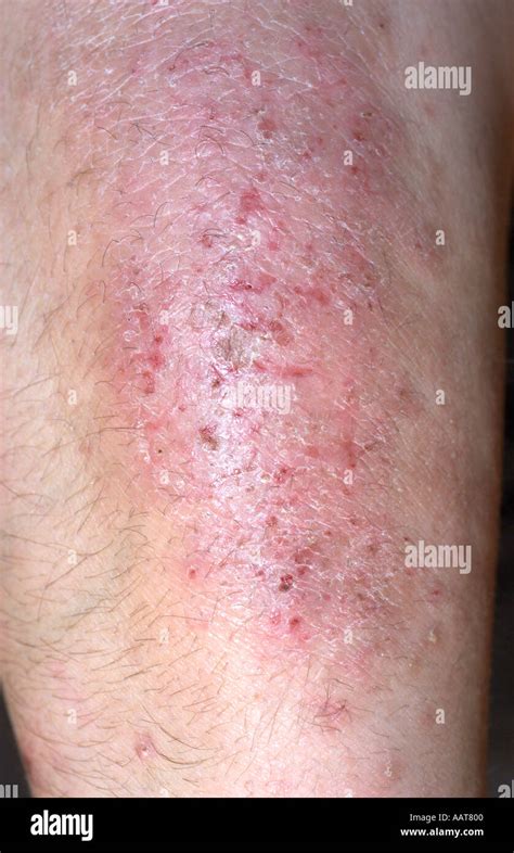 Skin Rash Of Eczema On The Forearms Extensor Surface Of A 35 Year Old