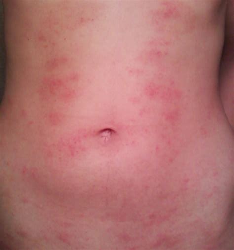 Eczema On Torso Eczemaexcellence