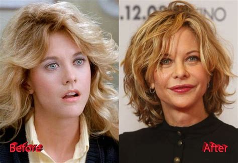 Meg Ryan Before And After Cosmetic Surgery Plastic Surgery Mistakes