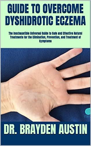 Guide To Overcome Dyshidrotic Eczema The Inexhaustible Universal Guide