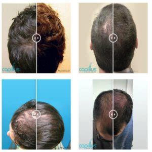 Hair Loss Treatment Hair Restoration Willow Health And Aesthetics