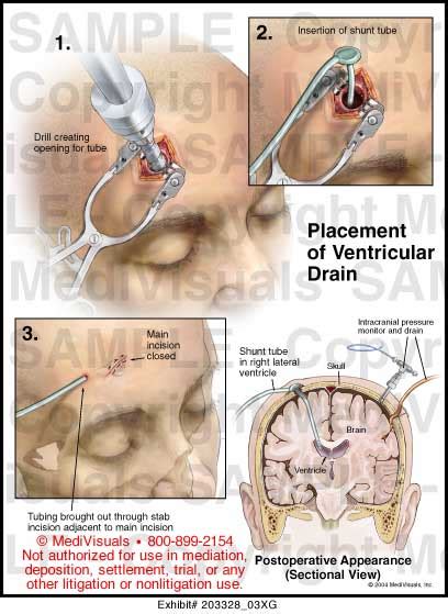 Medivisuals Placement Of Ventricular Drain Medical Illustration