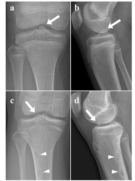 Tibial Plateau Avulsion Fracture