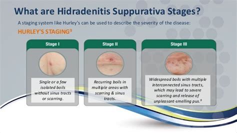 Hidradenitis Suppurativa Treatment With Antibiotics