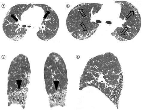 Specific Ct Signs Of Fibrosis In Connective Tissue Disease Associated