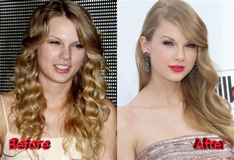 Taylor Swift Before And After Nose Job