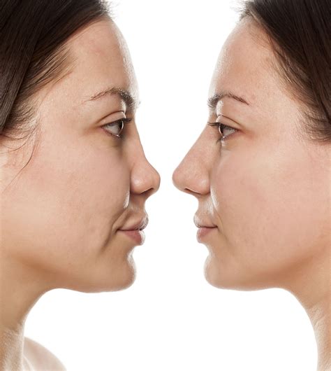 Nose Job Before And After Uk Non Surgical Nose Job Before After