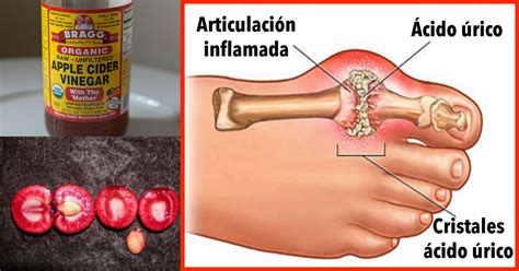 ácido úrico Como Tratar