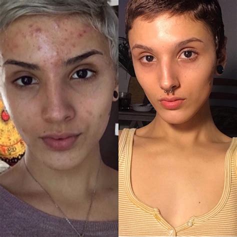 This Woman Went Vegan And Used Retinol To Clear Up Her Skin Newbeauty