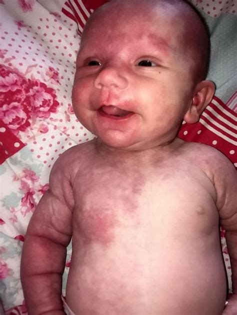 Lincoln Mum Hides Daughter Born With Purple Birthmarks Away Amid