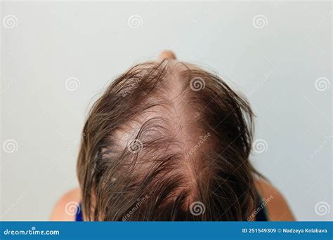 Hair Loss In The Form Of Alopecia Areata Stock Image Image Of Scalp