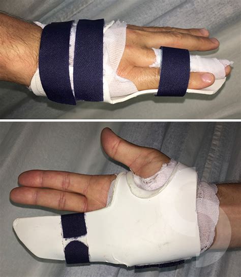 Custom Made Splint Used In Rehabilitation Of Finger Fractures Dr Sonja Cerovac
