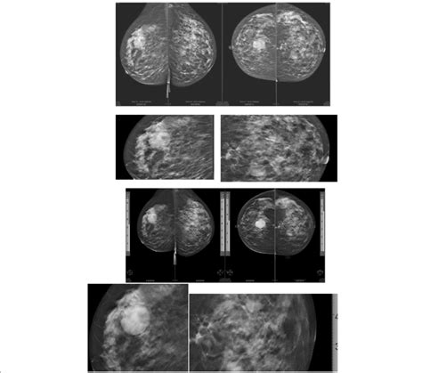Sixty Five Year Old Female Mammography Cc And Mlo Views Acr C
