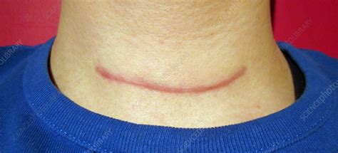 Scar Tissue After Thyroid Surgery