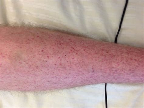Petechiae Skin Rashes On Legs
