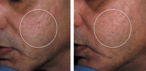 Left Baseline Right One Month After Three Microneedle Rf Treatments