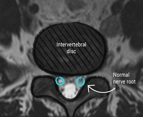 Minimally Invasive Herniated Disc Surgery CCV Montpellier