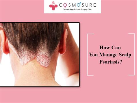 How Can You Manage Scalp Psoriasis Cosmosure Clinic