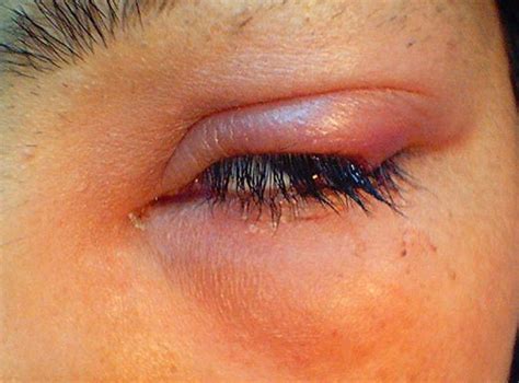 Swollen Eyelid Causes Treatment Symptoms Pictures