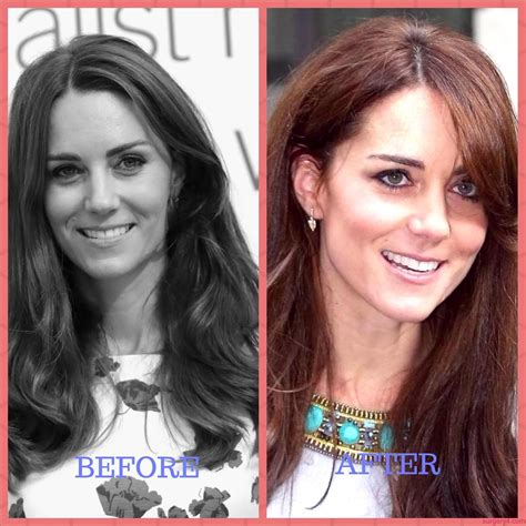 Kate Middleton Nose Job Plastic Surgery Before And After