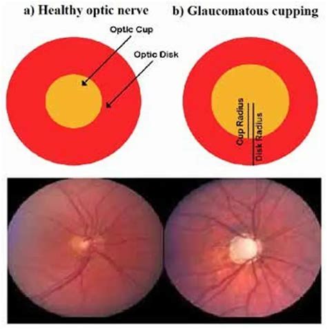 What does c&sol;d stand for? Optic Nerve Cupping - Nova Eyecare