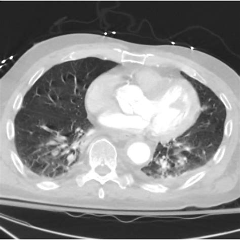 Preoperative Chest Ct Demonstrating Bilateral Areas Of Ground Glass