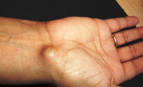 Ganglion Cyst Flickr Photo Sharing